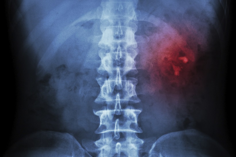 Benign Prostat Hiperplazisinde Lazer Uygulamaları: Hangisi Seçilmeli?