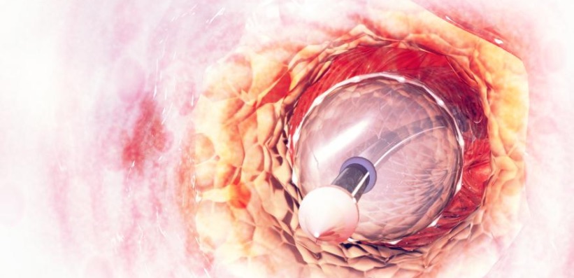 AF’nin Kateter Ablasyonu İçin Zor Sol Atriyal Transseptal Girişte Atriyal Balon Septoplasti